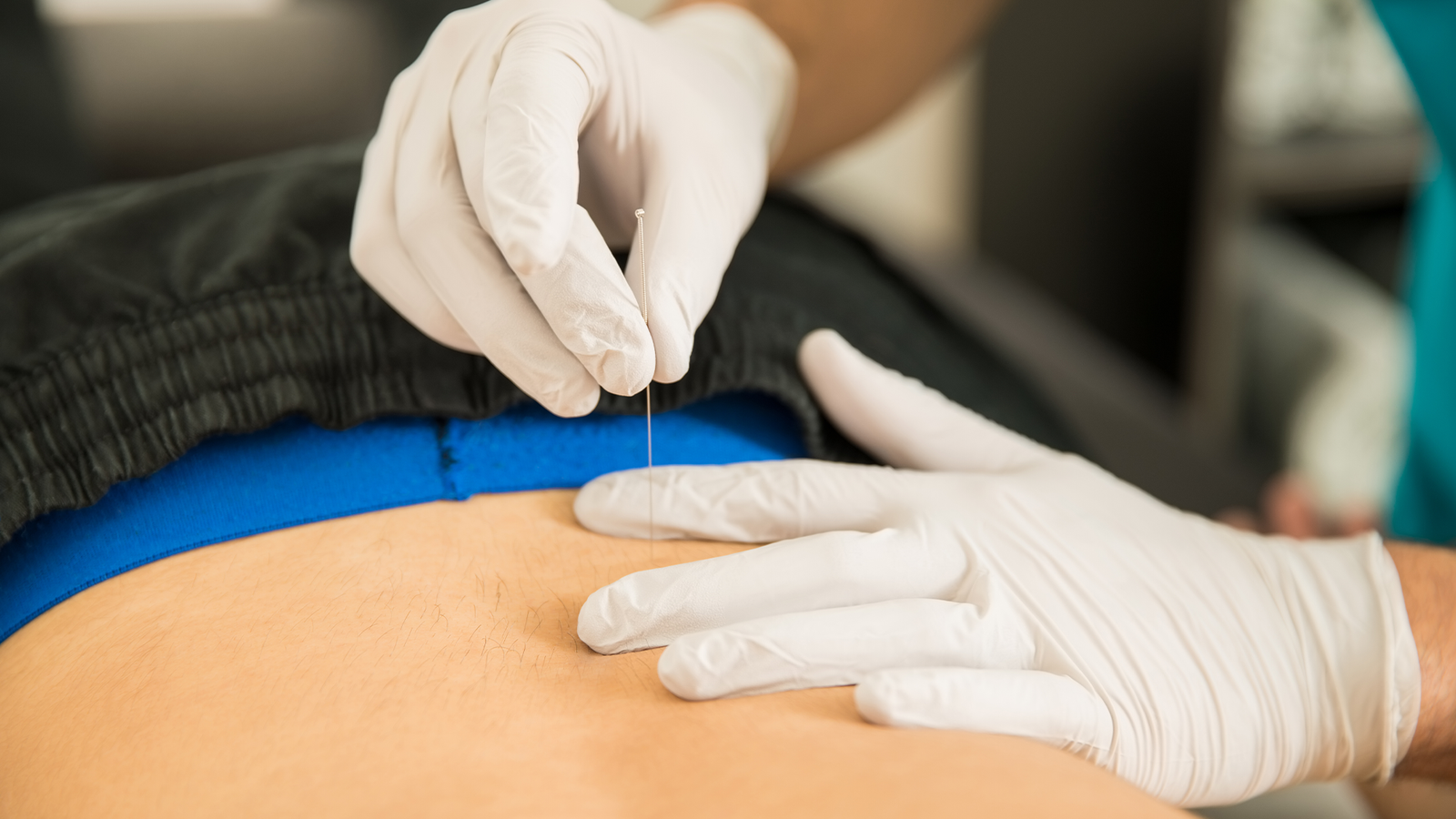 Intramuscular Stimulation (IMS) / Dry Needling